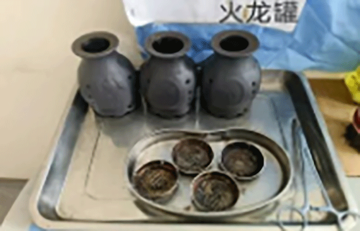 东明县人民医院:骨科引入&ldquo;火龙罐&rdquo;新技术 为患者带来康复新体验