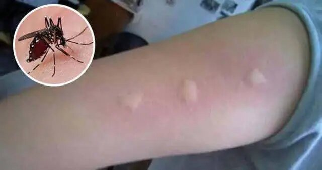 【健康山东行动】健康知识普及行动：夏季蚊虫叮咬防护要点